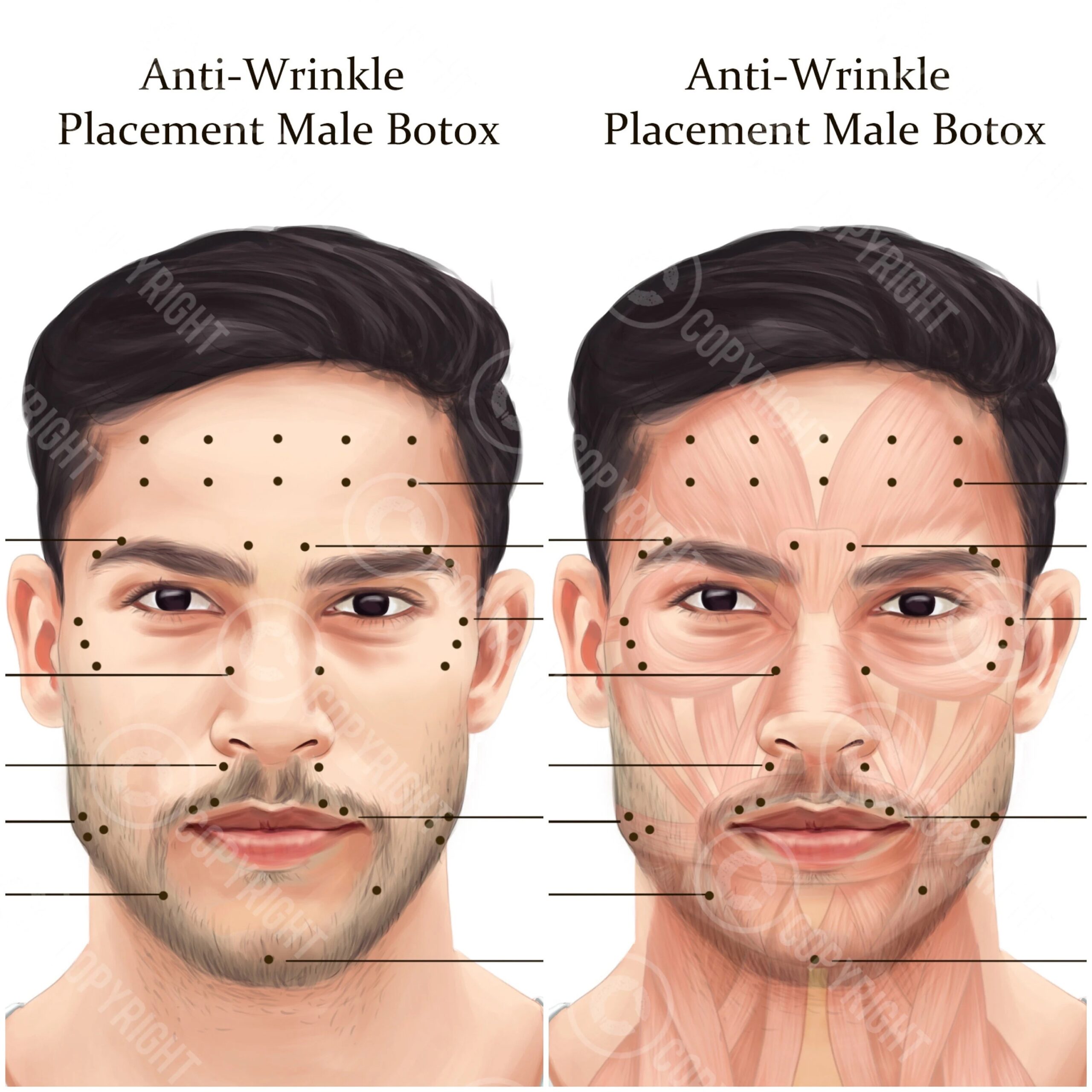 Printable Botox Injection Face Map Etsy